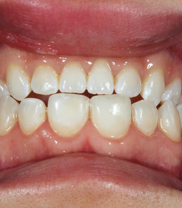 Sonrisa después del aclaramiento dental