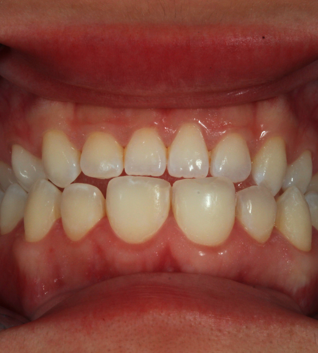 Sonrisa antes del aclaramiento dental