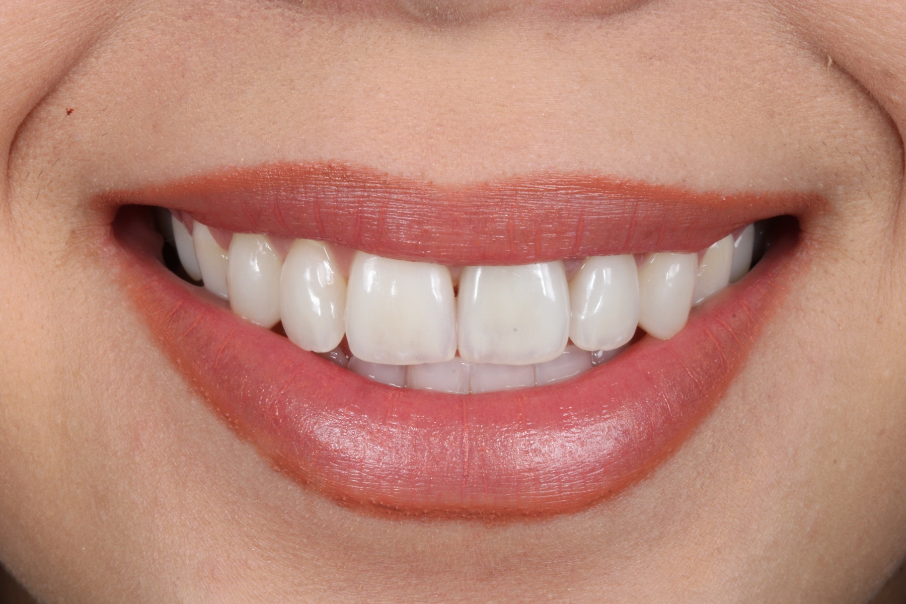 Resultado estético de carillas dentales