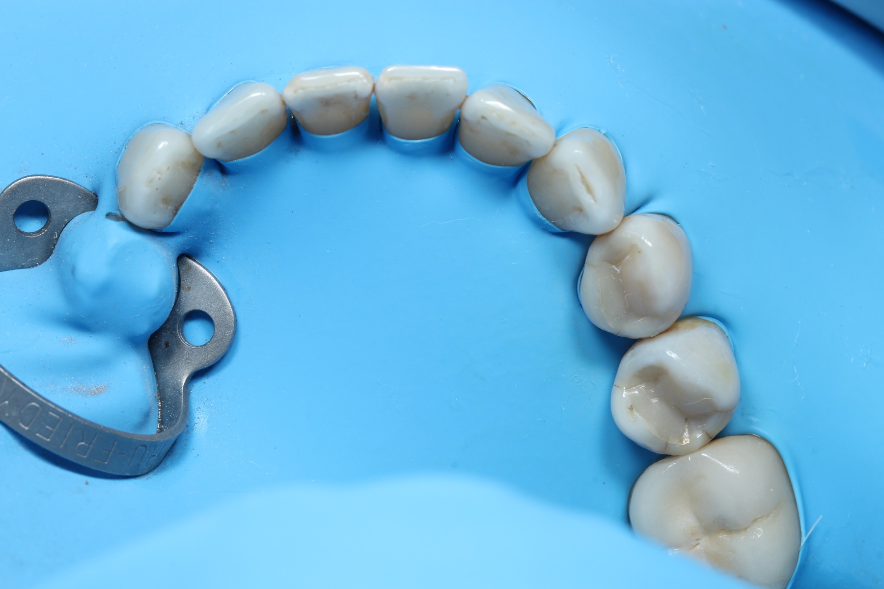 Resultado final de resinas y eliminación de caries