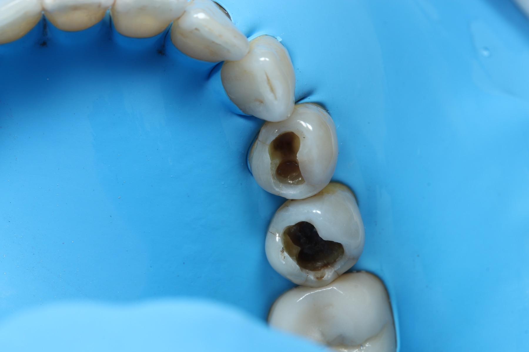 Procedimiento de resinas y eliminación de caries