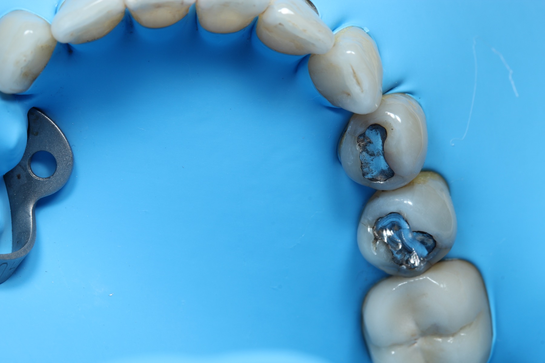 Estado inicial del caso de resinas y eliminación de caries